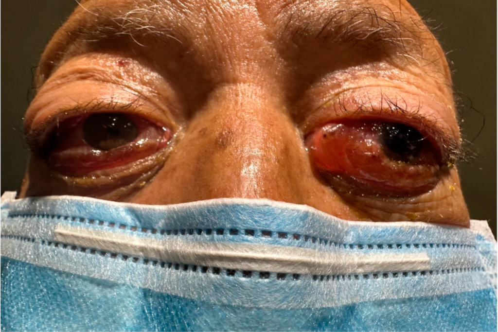 Understanding Mikulicz’ Disease and Related Treatments