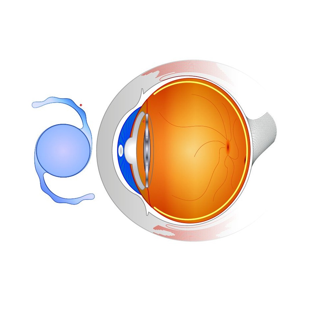 CATARACT LENS SURGERY