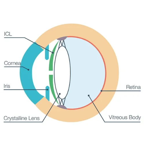 ICL SURGERY