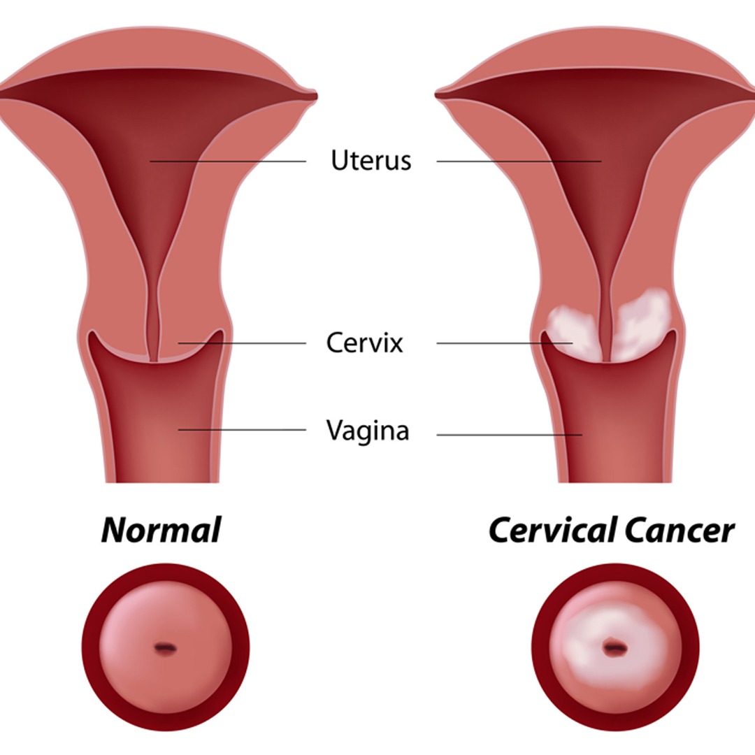 PAP SMEARS