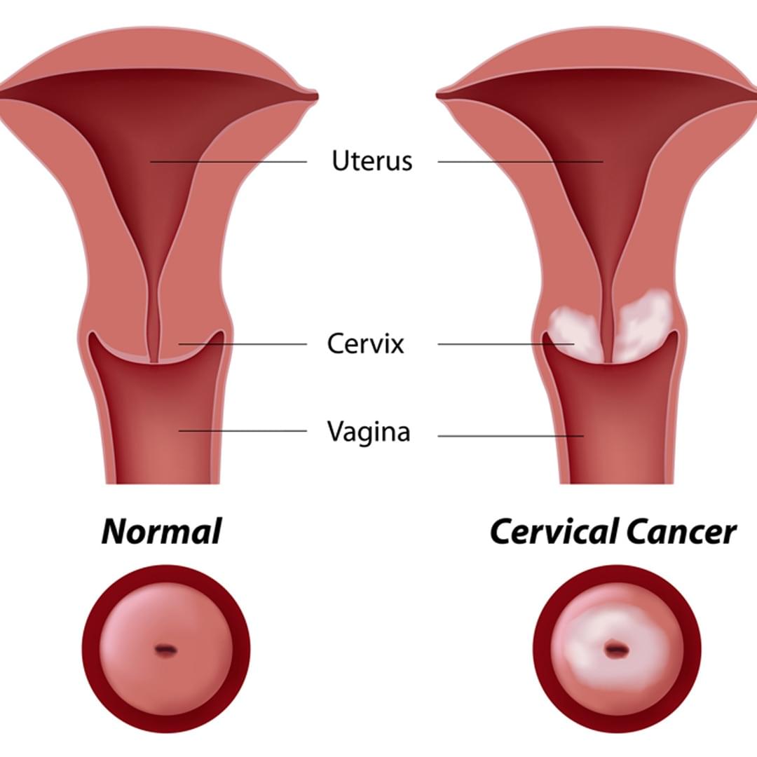 PAP SMEARS at Navjeevan hospital, best hospital in Panipat