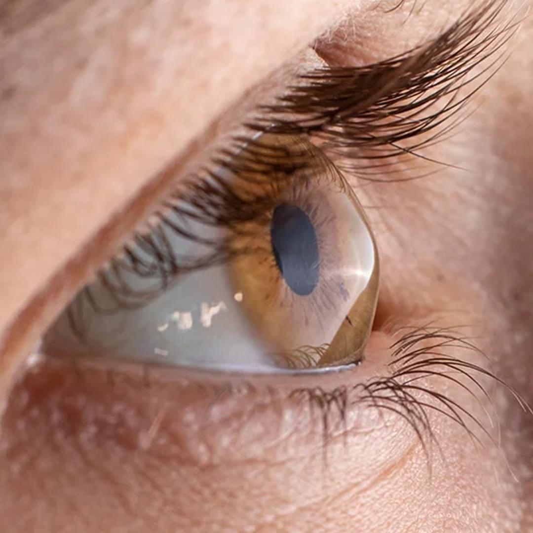 cornea treatment at Navjeevan hospital, best hospital in Panipat
