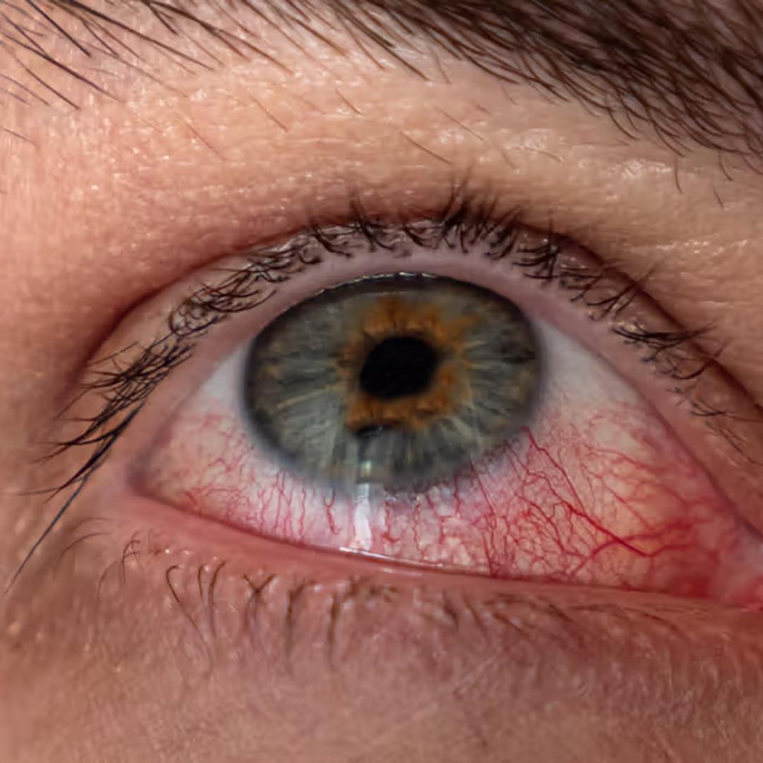Dry Eyes treatment at Navjeevan hospital, best hospital in Panipat