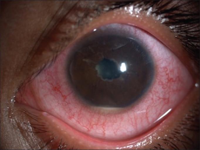 Uveitis at Navjeevan hospital, best hospital in Panipat