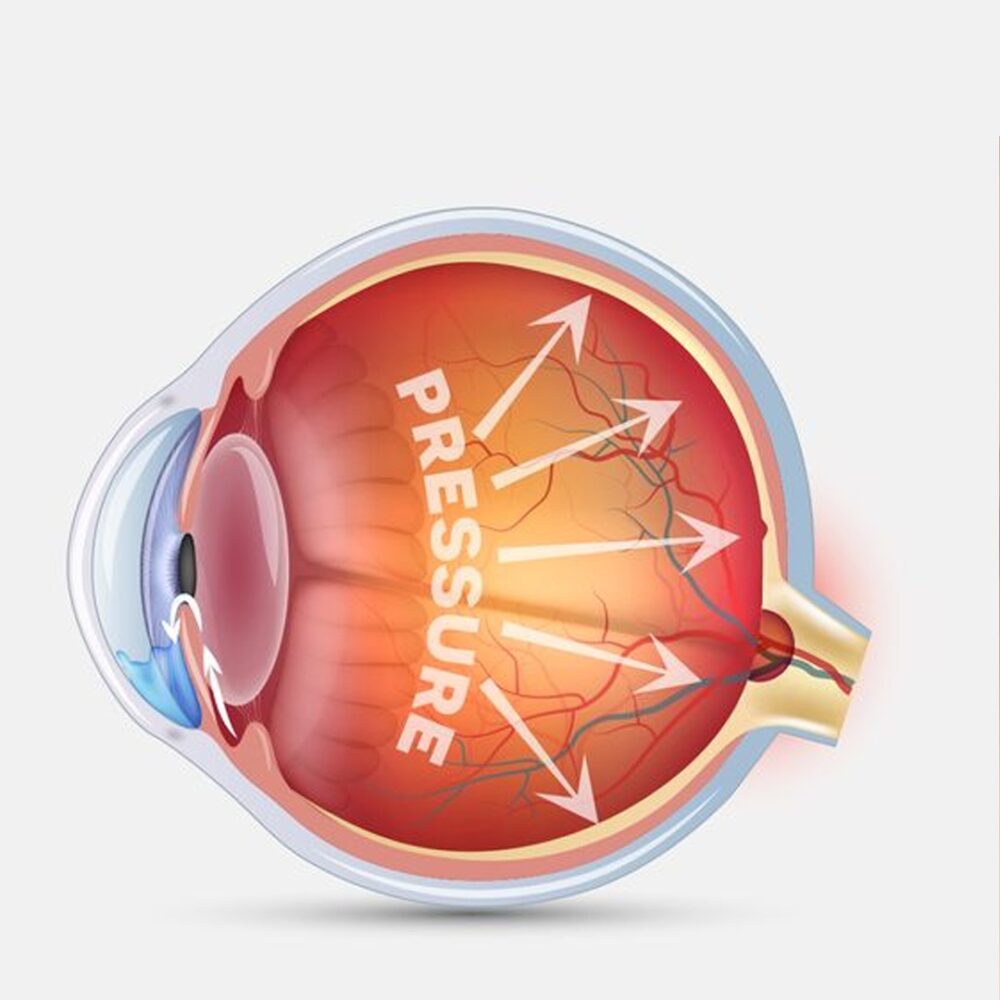 Gaucoma treatment at Navjeevan hospital, best hospital in Panipat